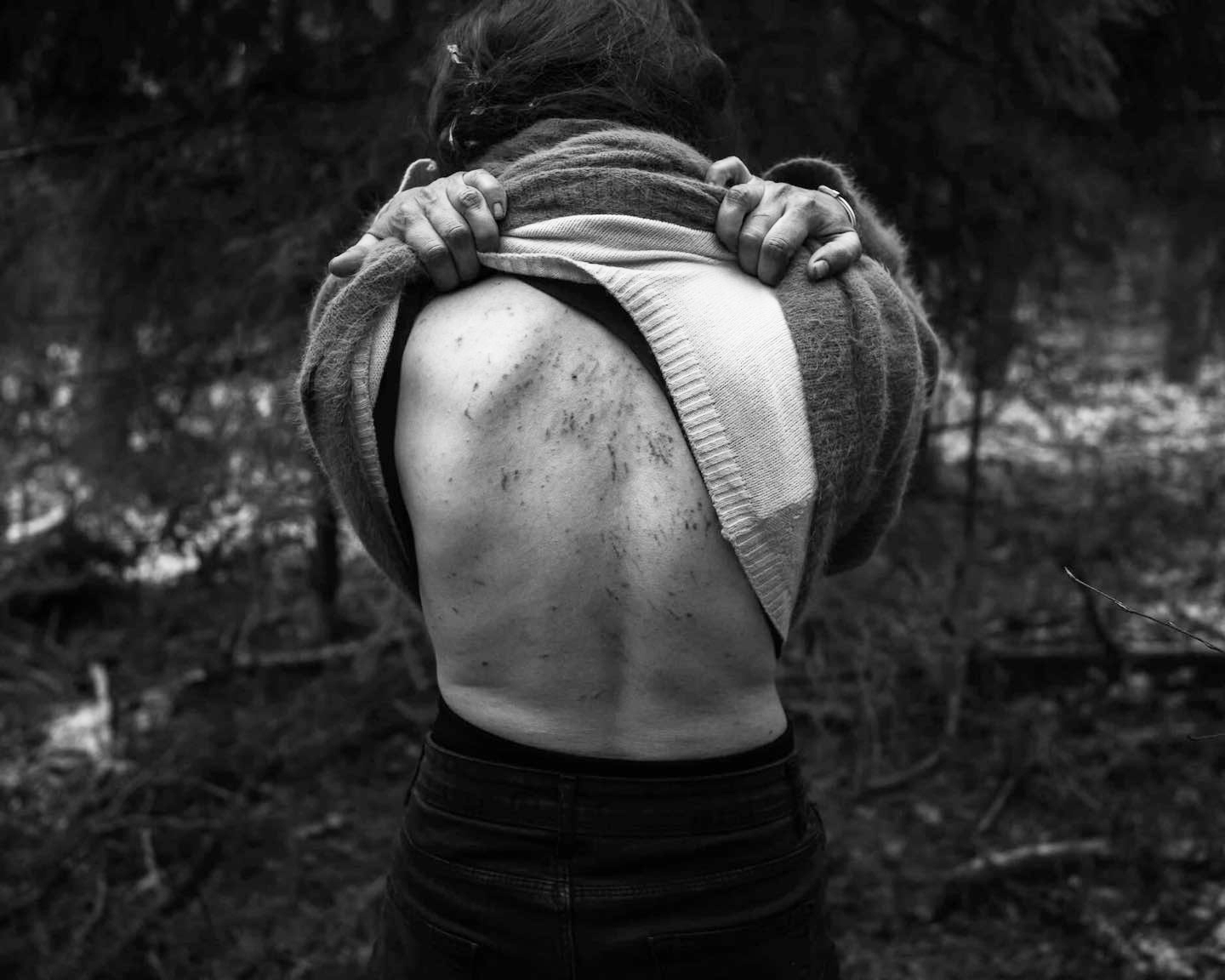 Так виглядає спина іракської жінки Асмін, яку побили співробітники білоруських спецслужб. Фото Кароль Григорук.