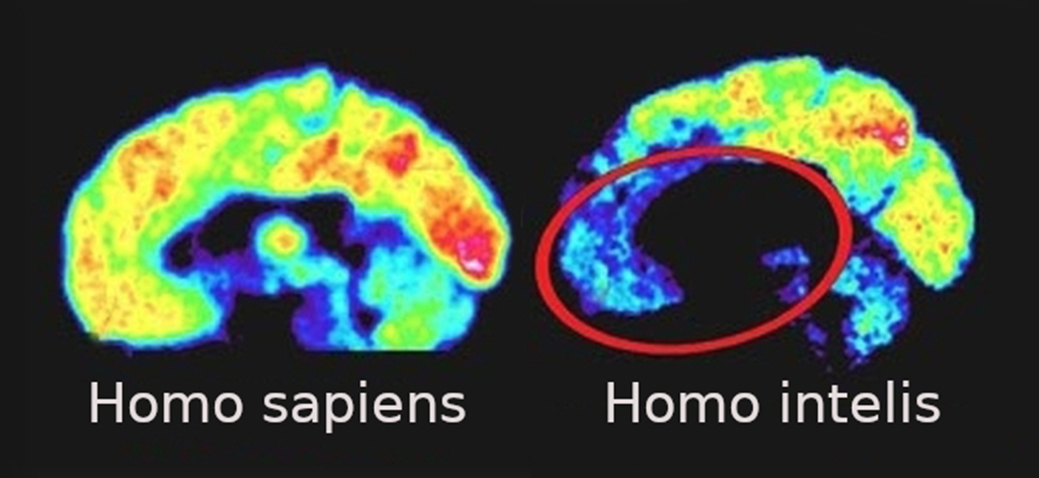 На МРТ-знімках добре видно, в чому відмінність між мозком звичайної людини (фото ліворуч) та мозком психопата.